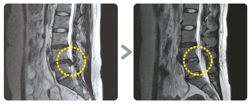 요추 디스크 제거술 수술 전후 MRI 비교